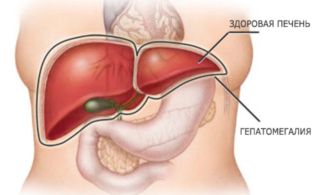 Новости про - Гепатомегалия печени, симптомы у взрослых и детей и как выздороветь