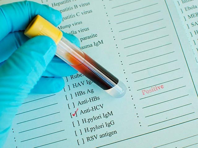 Новости про - Антитела к гепатиту С - причины появления, расшифровка анализа при обнаружении в крови антител после гепатита С